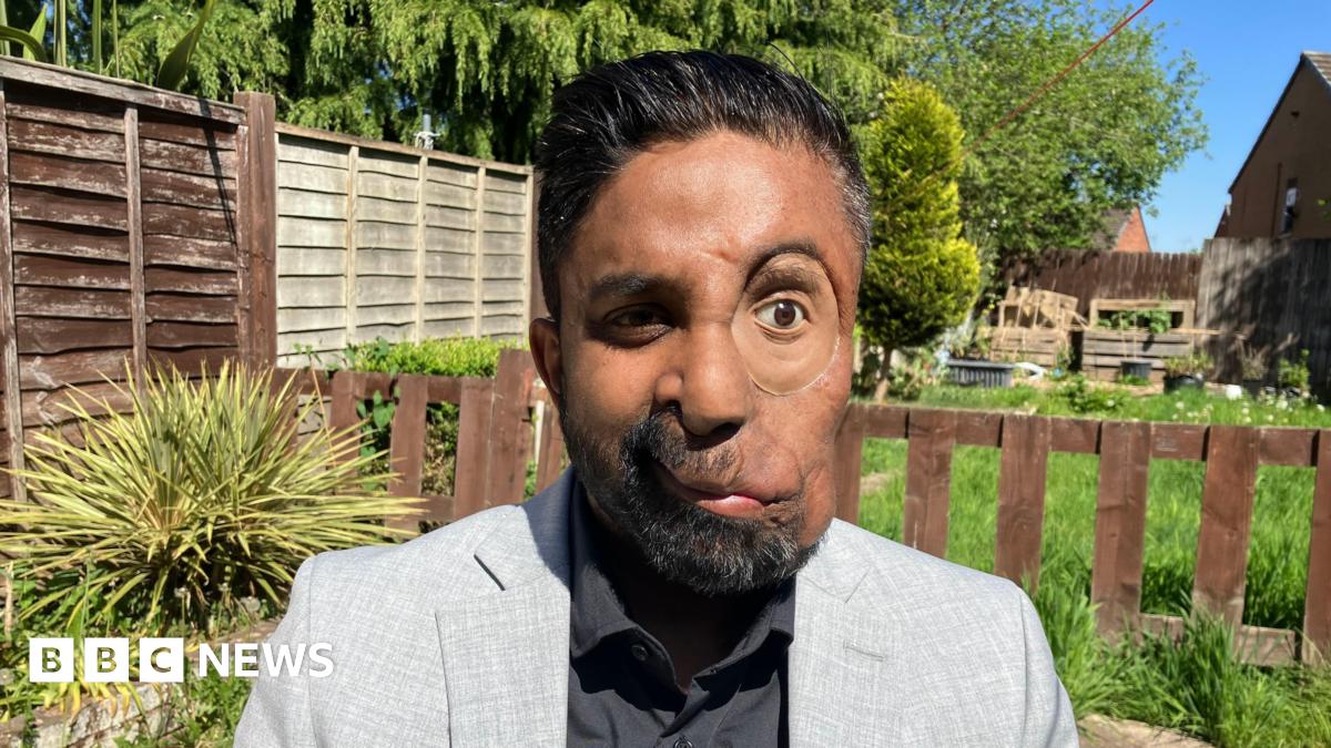 The Emotional Toll Of Facial Disfigurement: A Personal Account Of Rejection The Emotional Toll Of Facial Disfigurement: A Personal Account Of Rejection